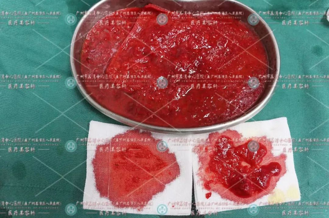 宝妈产后下垂，注射了奥美定隆胸后乳头溃烂坏死